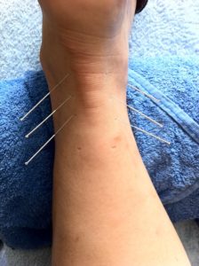 dry needling for athletes